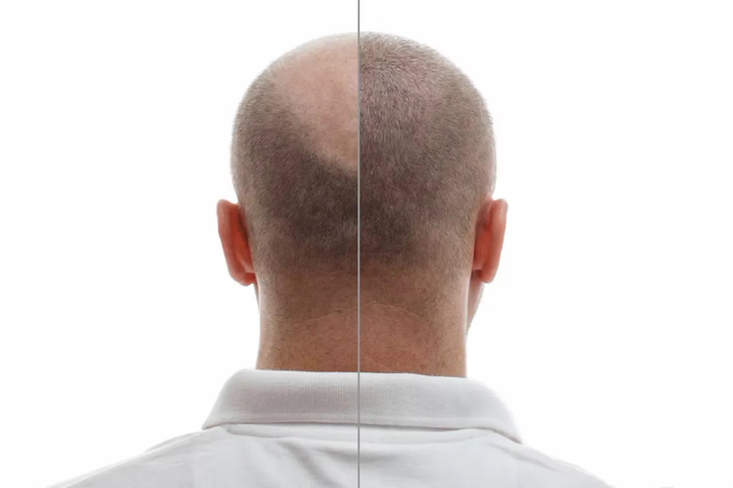 پوستر طرح سر مرد قبل و بعد از کاشت مو